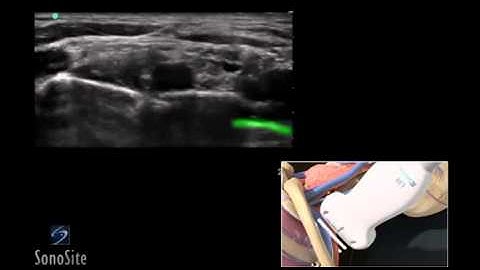 How To: Ultrasound Guided Interscalene Nerve Block 3D Video