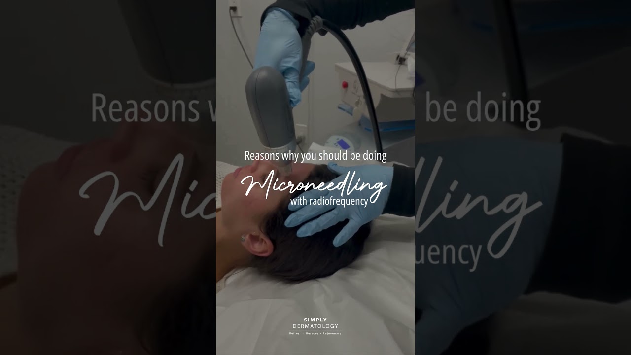 Reasons Why You Should Be Doing Microneedling RF | Simply Dermatology | Dr Kally Papantoniou