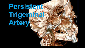 Persistent Trigeminal Artery: 3D Reconstruction of Anatomy