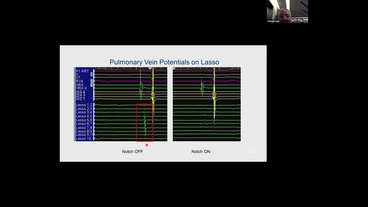Intracardiac signal processing Biophysics of Cardiac Ablation by Prof  Ahmed Nabil, MD