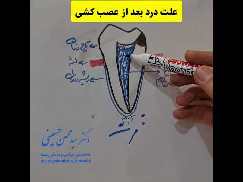 علت درد بعد از عصب کشی