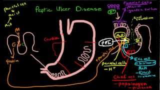 Peptic Ulcer Disease Pathophysiology