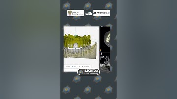 Importing optical scan and AI segmentation done by dentalsegmentator in Atomica AI