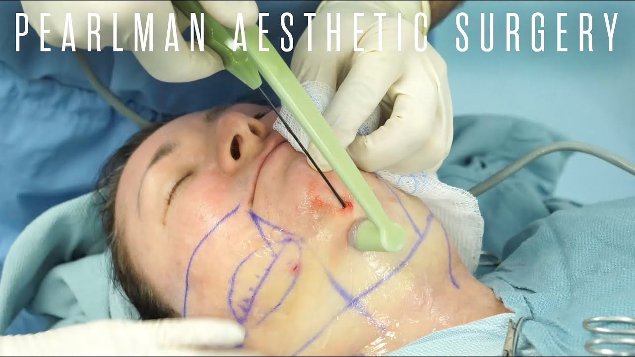 Scarless Facelift with FaceTite Pearlman Aesthetic Surgery YouTube