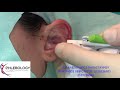 Earfold Plastic Surgery | Plastic Clinic