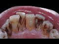 55 yo. Male&#39;s Teeth | Smokers | Scaling | Dentist | Dokter Gigi Tri Putra