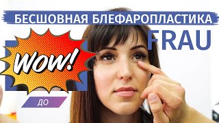Блефаропластика (пластика нижних век) - безшовная методика Фрау Блефаропластика (пластика нижних век) - безшовная методика Фрау