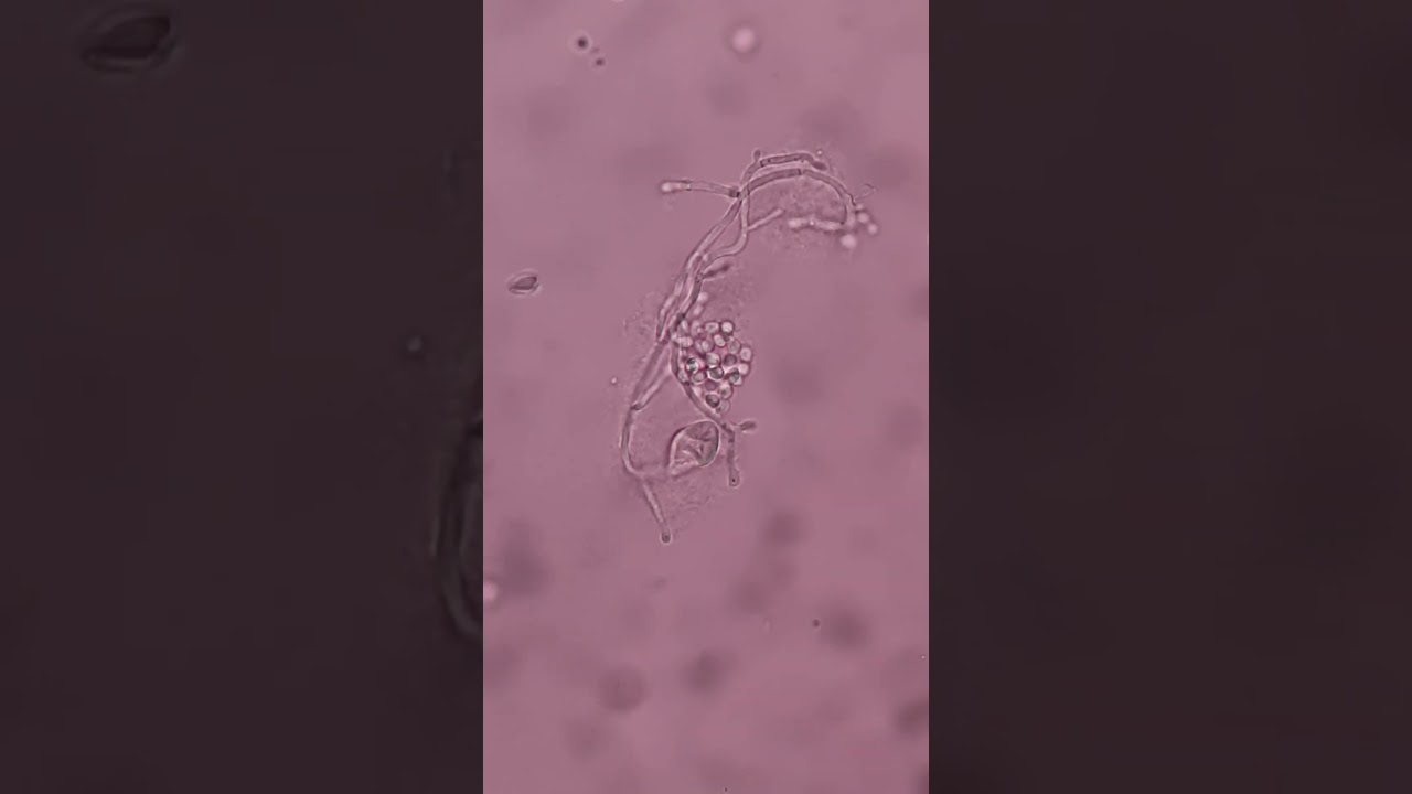 Грибковые гифы в моче #микроскоп #шорты