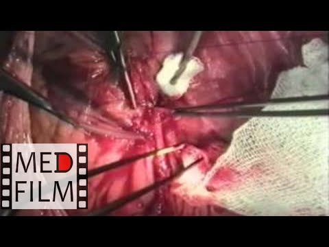 Video: Angioplastika Periferne Arterije I Postavljanje Stenta