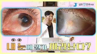 눈 흰자위에 뭔가 있다❓ 눈동자로 흰 살이 들어온다❓ [의학박사 박진형 대표원장]