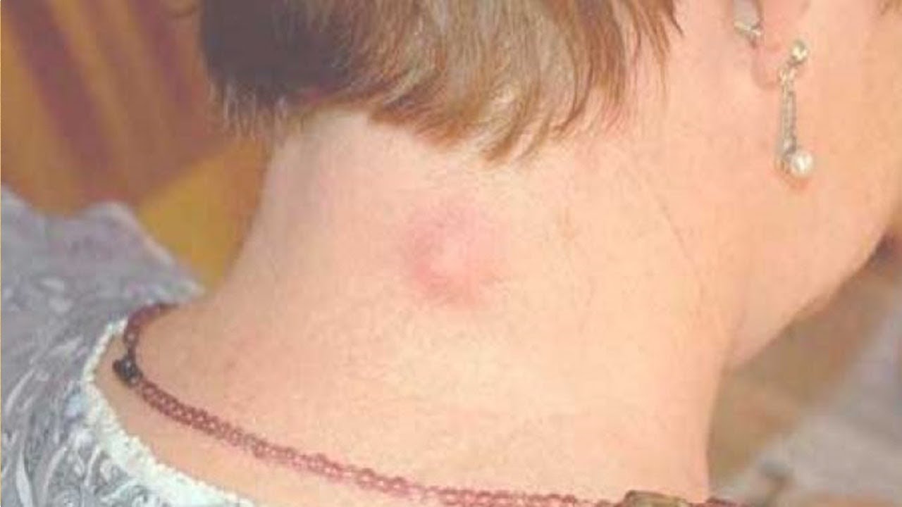 Resultado de imagen para Remedios caseros para los granos o quistes sebáceos en la parte de atras de tu cuello