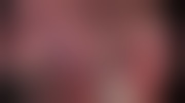 Segment 4b laparoscopic liver resection for single breast liver metastasis