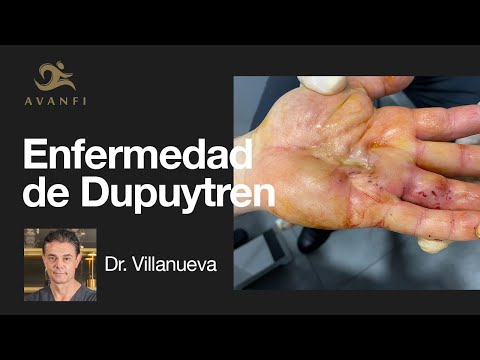 Dupuytren: Causas, Diagnóstico y Tratamiento | Avanfi