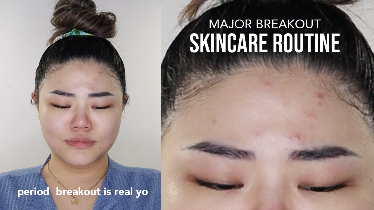 5 highly effective skincare to treat acne YouTube