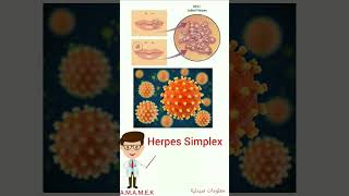 الهربس الفموي البسيط / herpes simplex virus /معلومات صيدلية