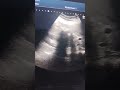 Renal hydatid Cyst | Renal complex cyst | Renal mass Supra renal | Doppler Ultrasound | Radiologist