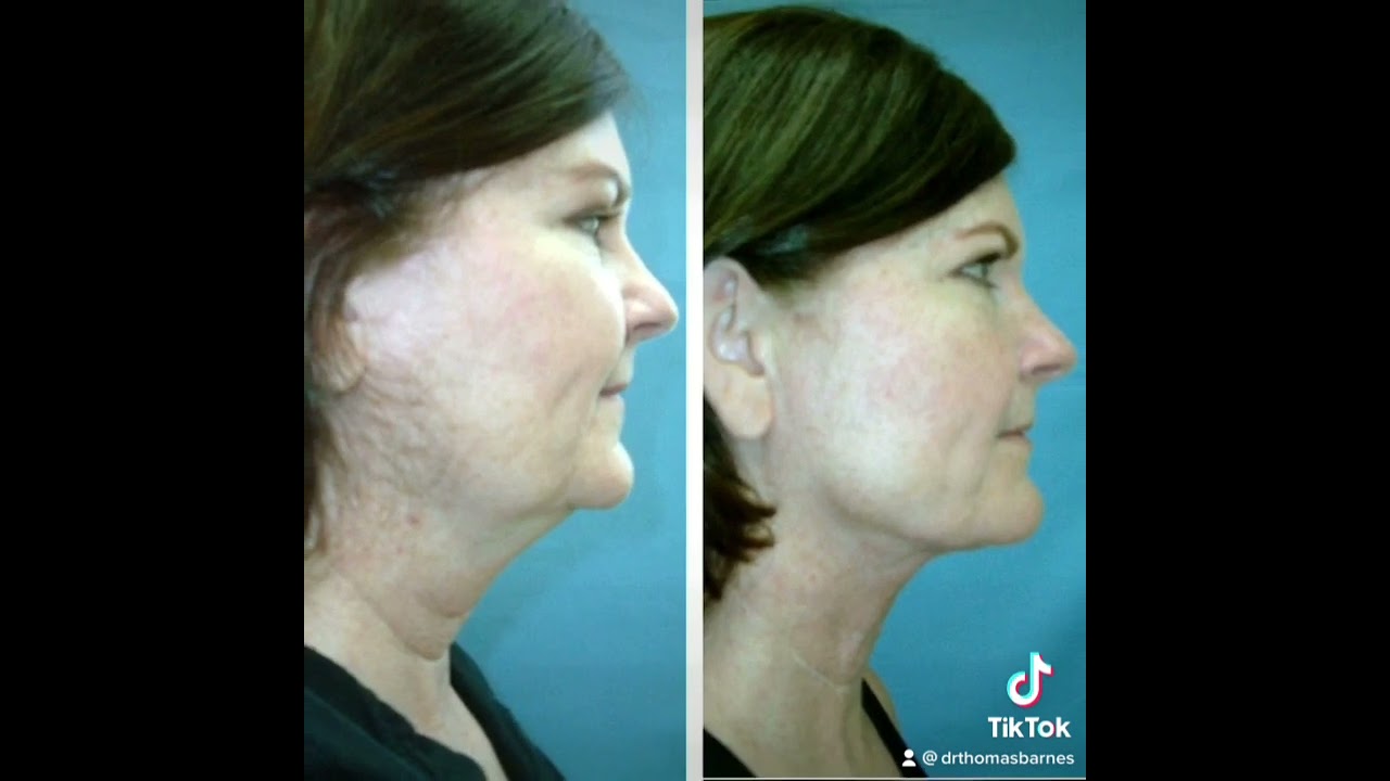 AWAKE NECK LIPO RESULTS! MUST SEE!  NEWPORT BEACH COSMETIC 