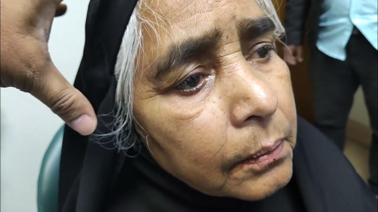 Jaw Tremor, pathognomic tremor in Parkinson's disease YouTube