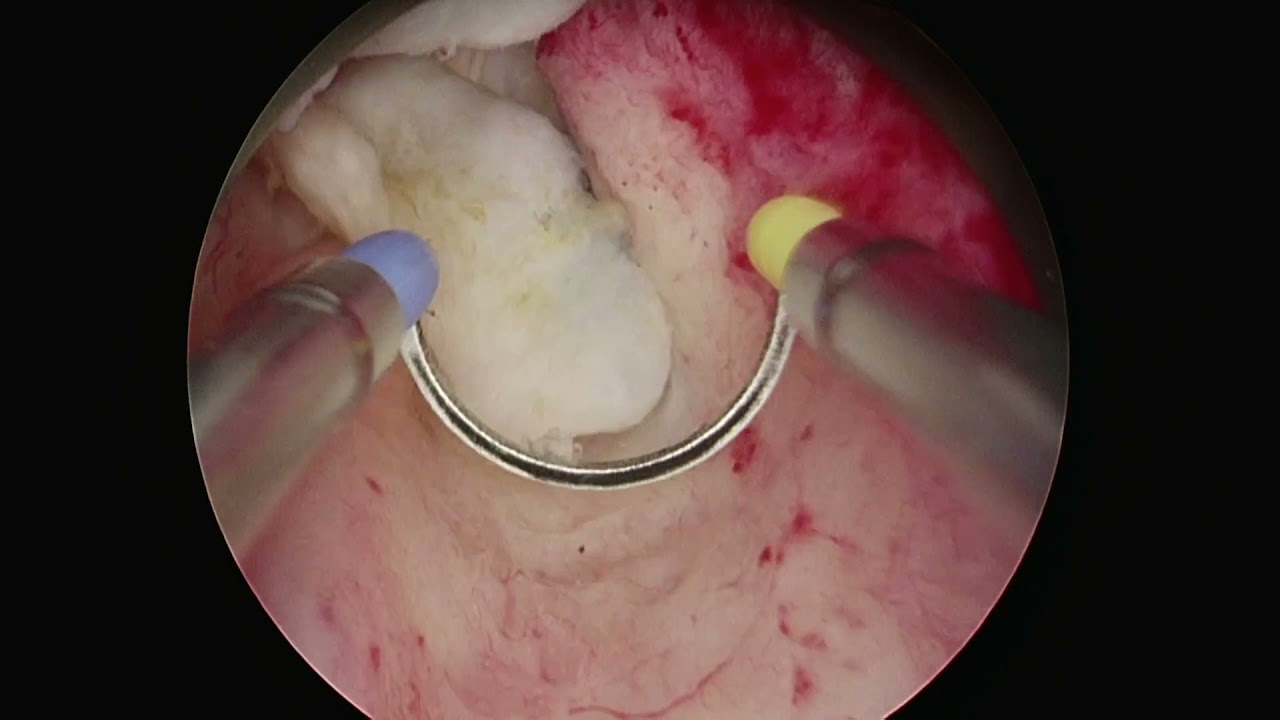 ICS 2021 Abstract #573 Transurethral Bipolar Enucleation of the Prostate (TUBE) using the Olympus Band Electrode - step by step technique