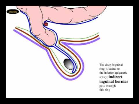 Direct and indirect inguinal hernia - YouTube