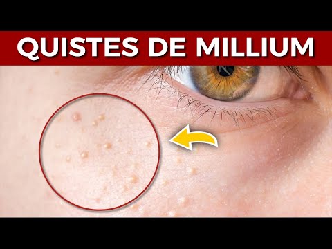 Milia cysts: What are they and how to get rid of them? 👩🏻‍⚕️ #milia #skin #information