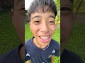 Cậu bé đáng thương và vết bớt đen trên mặt #shorts