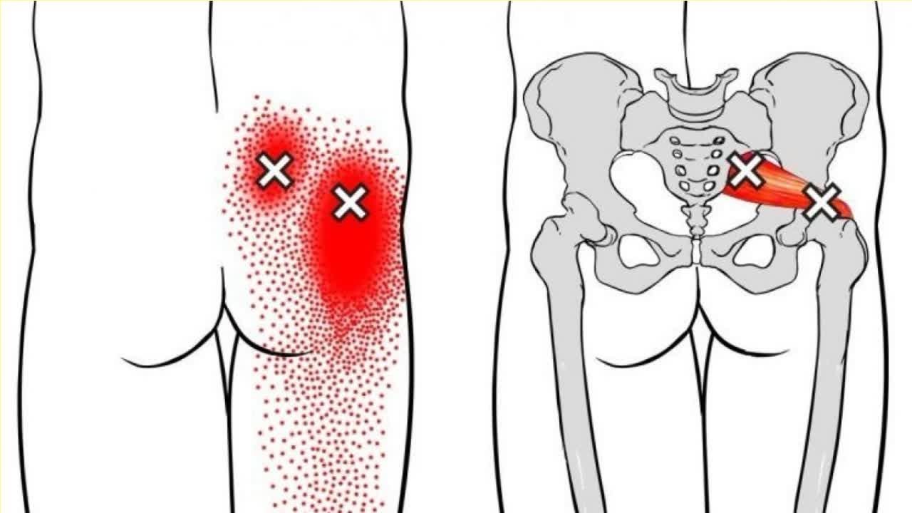Боль в ягодице и пояснице. Триггерные точки грушевидной мышцы. Триггерные точки седалищного нерва. Синдром грушевидной мышцы триггерные точки. Миофасциальный синдром малой ягодичной мышцы.