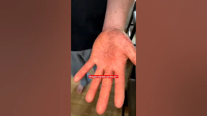 hand foot and mouth be spreading through WI like w...