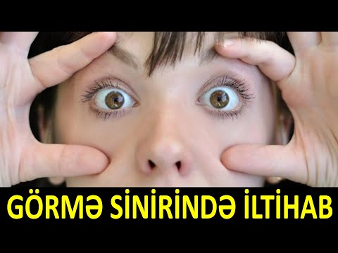 Video: İgnis görmə qabiliyyətini bərpa etdi?