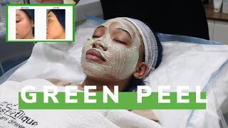 Getting Rid Of Dark Marks/Hyperpigmentation Fast With A Green Peel