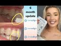 Invisalign Overbite Correction! - 6 Month UPDATE with before and after pics!