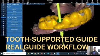 How to Design a Tooth-Supported Surgical Guide in RealGUIDE | Step-by-Step Workflow