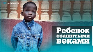 В Чечне планируют провести уникальную операцию африканскому мальчику с зашитыми веками