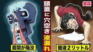 【実話】頭蓋骨に穴が空いた男。鼻から...脳脊髄液がダダ漏れ。