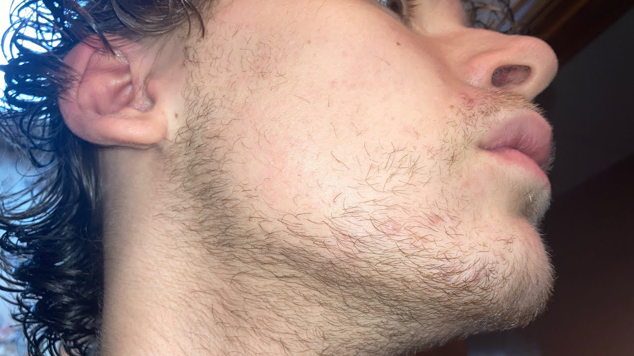 Minoxidil and Derma roller (Week 35) (Month 8) - YouTube