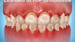 Waarom Goed Poetsen? - Top Orthodontie