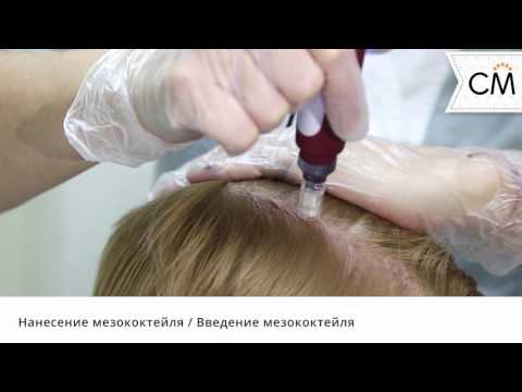 Фракционная мезотерапия кожи головы | Сан Медик