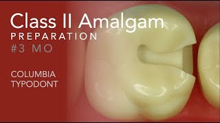 Class II Amalgam Preparation #3 MO