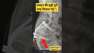 स्पाइन की हड्डी का खसकना✅ Slippage Of Spine 💥 #spondylolisthesis #spineproblem #spineproblems #spine