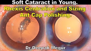 Soft Cataract in Young. Rhexis Centration and Sizing, Anterior Capsule Polishing - Dr Deepak Megur