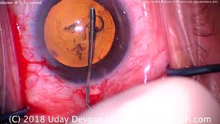 Slow motion cataract surgery incisions, capsulorhexis, and hydrodissection