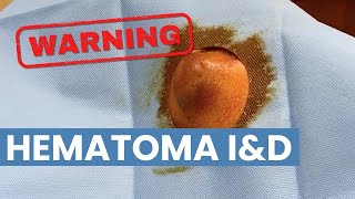 Hematoma - Incision and Drainage | CONTOUR DERMATOLOGY