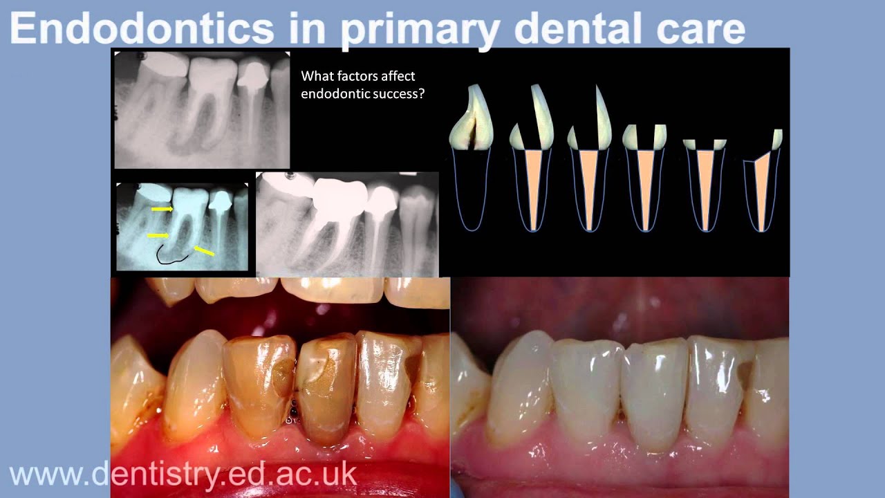 Masters in Primary Dental Care, Edinburgh Dental Institute YouTube