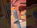 Bladder Leaks? 🇱🇷 Try This Before Surgery! 😱 (V-Tone Explained)