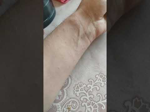 Что делать, если укололся крапивой?