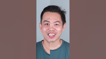 Trả Lại Nụ Cười Tự Tin Nhờ Thẩm Mỹ Răng Sứ #shorts