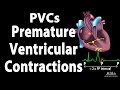 Premature ventricular contractions pvcs animation