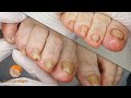 Treatment for the feet of the elderly [Podología Integral]