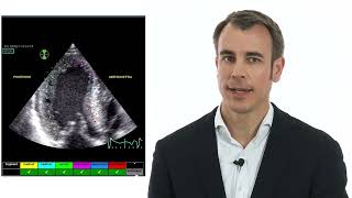 Regional strain and dispersion in a 30 y.o. with HCMP