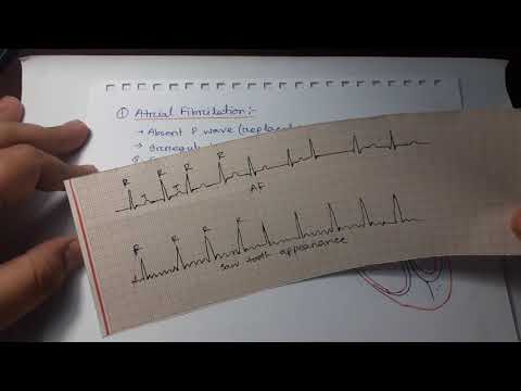 Video: Senarai Ubat AFib Biasa